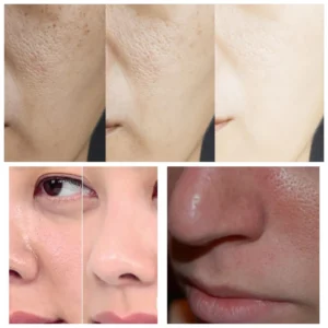 Làm Thế Nào Để Thu Nhỏ Lỗ Chân Lông